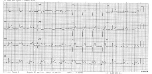 ECG Blog Post 1